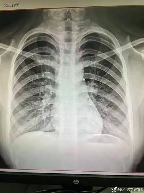 考虑支气管炎想看看各位老师有没有其他看法本人技士