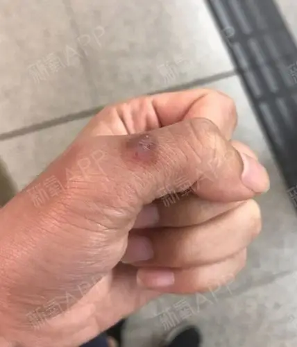 手上的这块疤痕已经两年多了