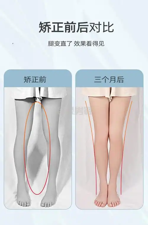 x型腿内八字矫正鞋垫o型腿外翻足内翻xo内外八字纠正器ox腿型儿童神器