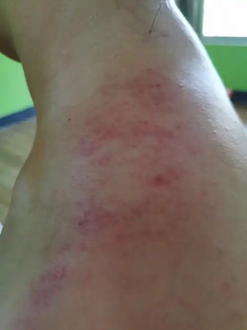 10月3日肩颈刮痧图