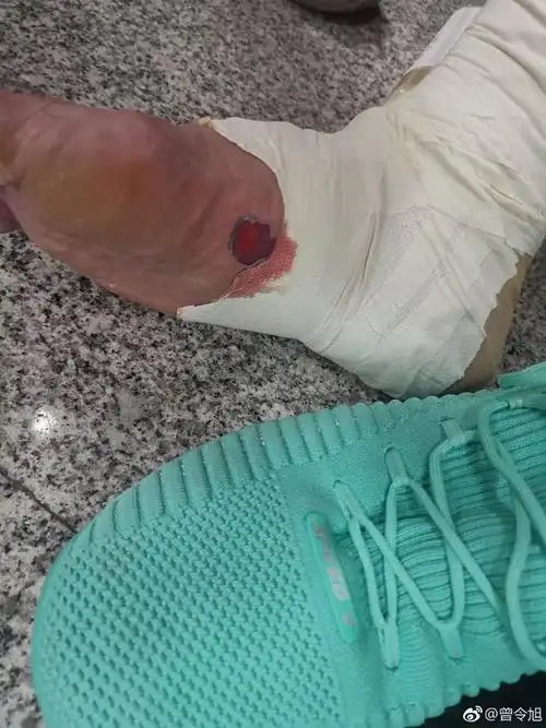 慎入!新疆大将展示脚底伤口 白袜子都被血染红了