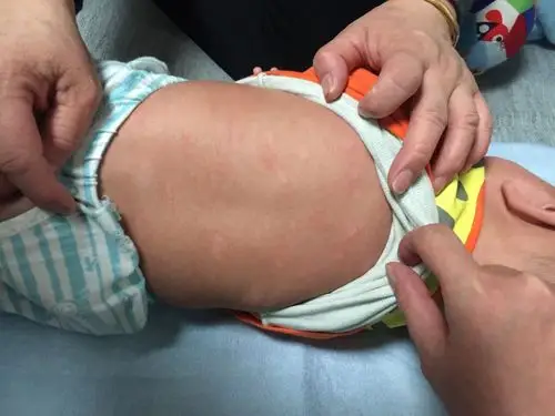 宝宝洗完澡后身上出了一片一片白色的和红色的是什么啊