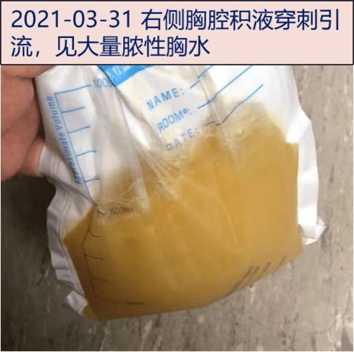 探案丨肺炎7个月活检3次终确诊