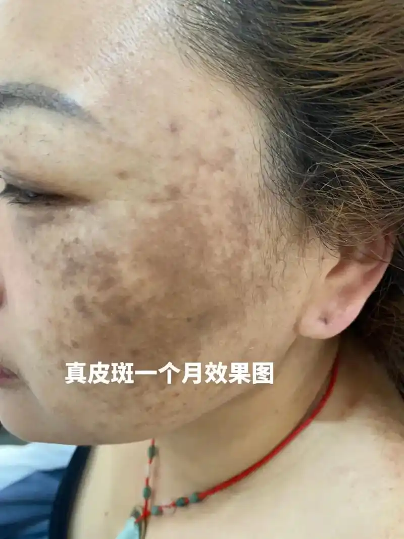 我要上热门76 #解决任何皮肤问题 #问题性皮肤管理 真皮斑 - 抖音