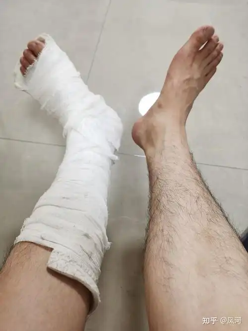 宁折不弯左脚第五跖骨基底粉碎性骨折随记三个月