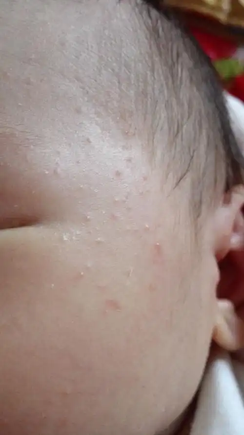 宝宝脸上出了好多痘痘!20天的婴儿!好担心的!用不用去医院?