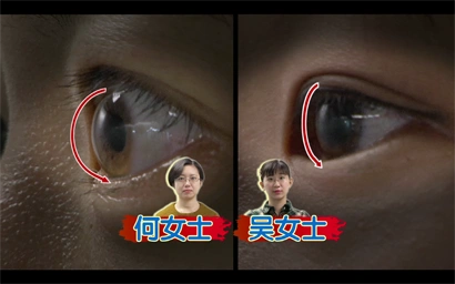 近视眼戴眼镜会使眼球变凸?专家解惑:并非如此