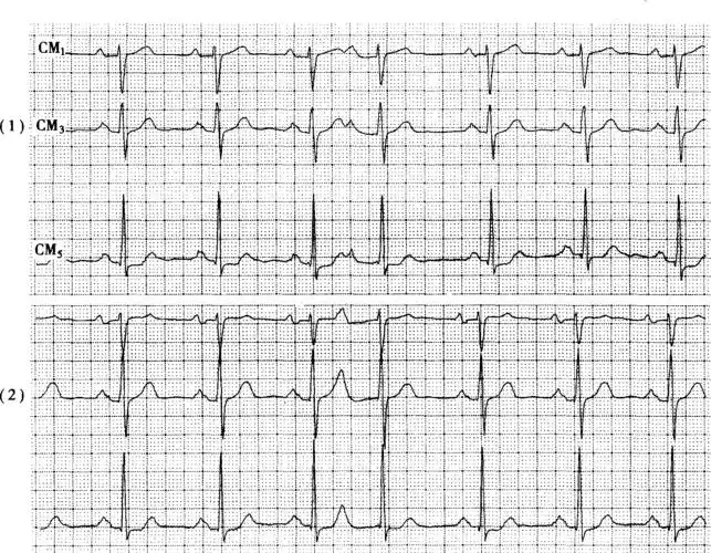 风心病,二尖瓣狭窄,左房扩大.