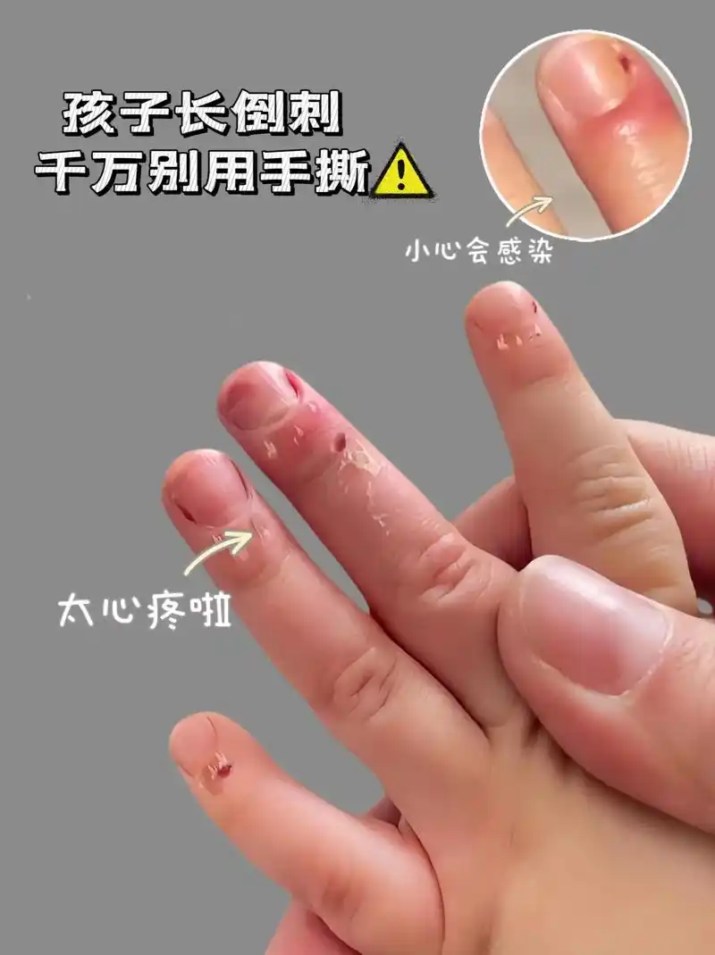 孩子长倒刺真的太疼太难受了 - 抖音