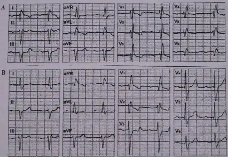 图20(13)p波高得出奇:三尖瓣下移心电图诊断:①p波高得出奇,肢体导联p