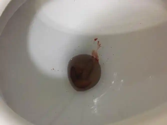 4月7号小孩子精神状况不错有说过屁股痛拉出来的大便有条