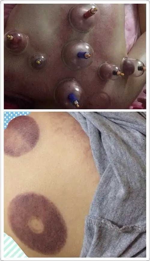 给肩膀拔罐肩贞穴好黑啊!求看!