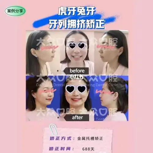 兔牙虎牙,牙列拥挤矫正前后效果_牙齿矫正_凸嘴_刘亦菲_青年路_牙列