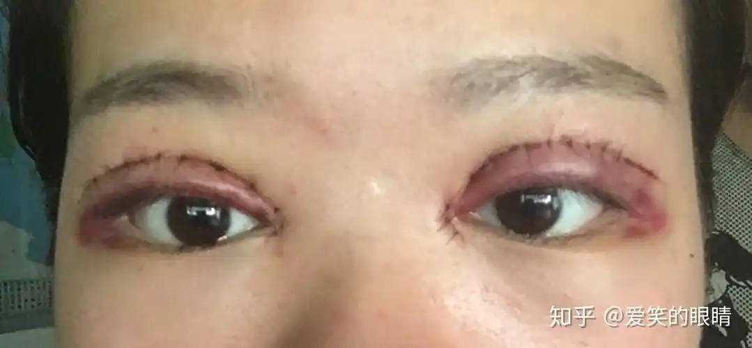 肿眼泡全切双眼皮 去脂去皮 双眼皮,开眼角 记录一下 .