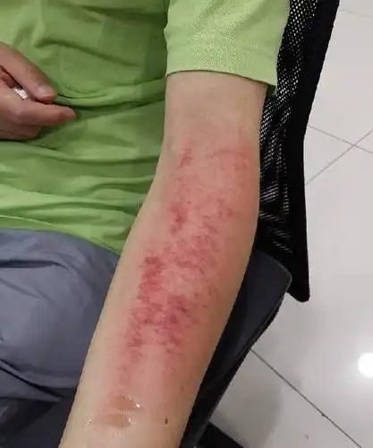 9.14一波三折的刮痧培训-别有病 byb.cn-纯自然疗法 攻克亚健康