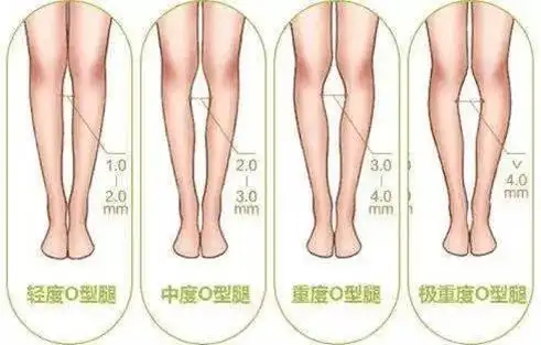 o型腿的预防与矫正