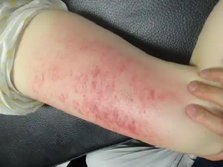 脾经,肝经也不含糊河北的学员胆经,膀胱经,小腿肚都出痧巨多山东学员