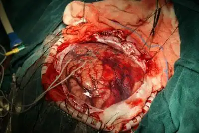 开颅手术的人可以买保险吗 意外开颅手术保险公司拒赔