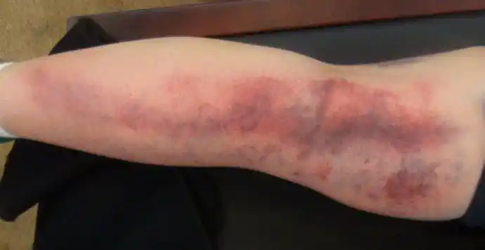 我的腿部出痧图先说跑步吧,开始跑步时,总觉得很累,要花很多时间才能