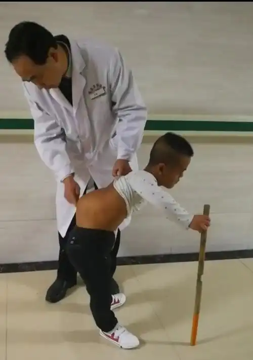 临泉泉河医院 | 小伙"驼背"二十余年,如今终于挺直腰杆抬头做人!