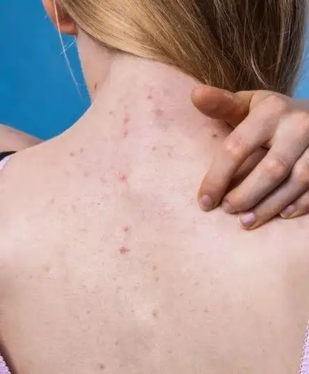 但有许多女孩,梅毒疹图片 男性,她们全身过程并无皮疹.