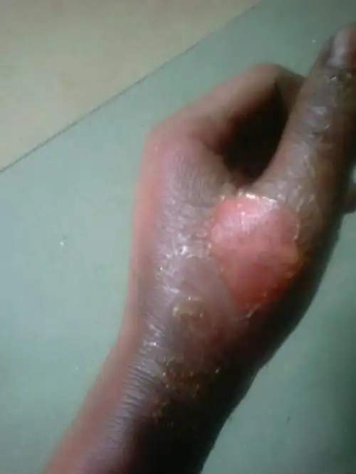 手被电火烧伤起水泡了,肿了起来该怎么办,好痛啊,求解,急急急