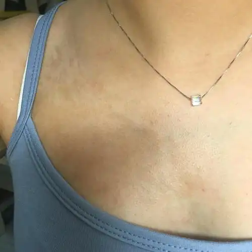 到长大爱美了才发现自己胸部右边有一大块浅褐色的斑妆的东西,去问了