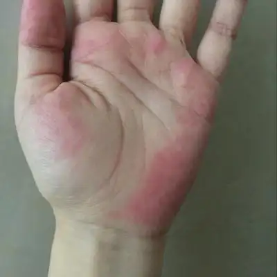 这几天,天天手掌很红,请问知道怎麼回事吗?有没有问题?