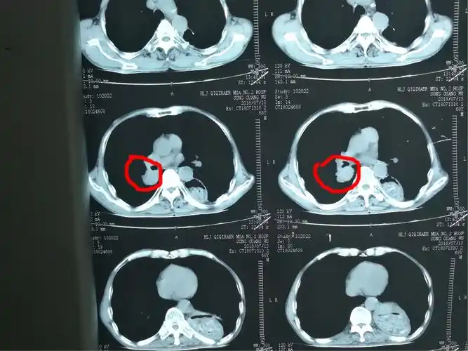 肺部恶性肿瘤,化疗栓塞3次肿瘤几乎消失
