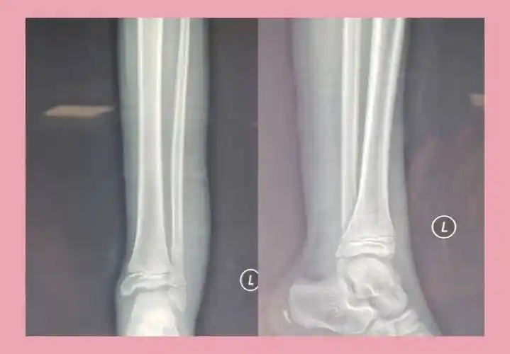 临床表现 :急性化脓性骨髓炎的致病菌多为金黄色葡萄菌