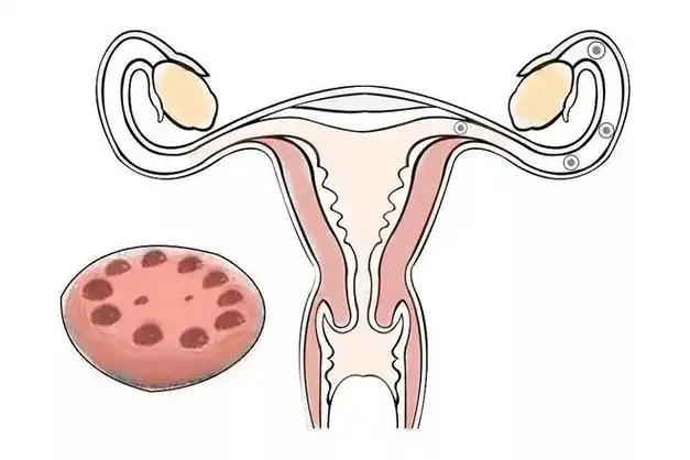 月经不调发胖不孕不可忽视的多囊卵巢综合征