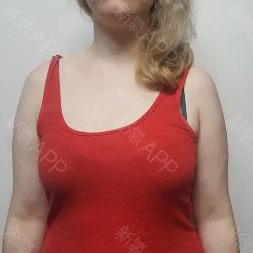 我有一颗a罩杯足够大的胸,但我一直希望有更丰满,更_圈子-新氧美容整