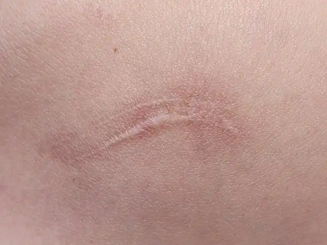 身上好几块小疤痕,先治疗一个看看效果~我的疤痕个主_圈子-新氧美容