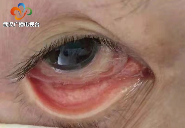 震惊老人眼睛不舒服医生从她眼里捉出5条活虫罪魁祸首竟是摸完宠物猫