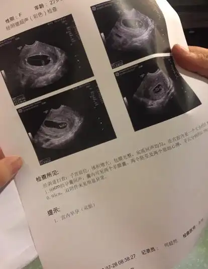 6周 6 胎心胎芽都有了!而且分裂成同卵双胞胎