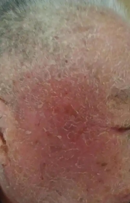 1月20日我住省立三院泌尿外科,晚上左右腿两侧出现红点,经与皮肤科