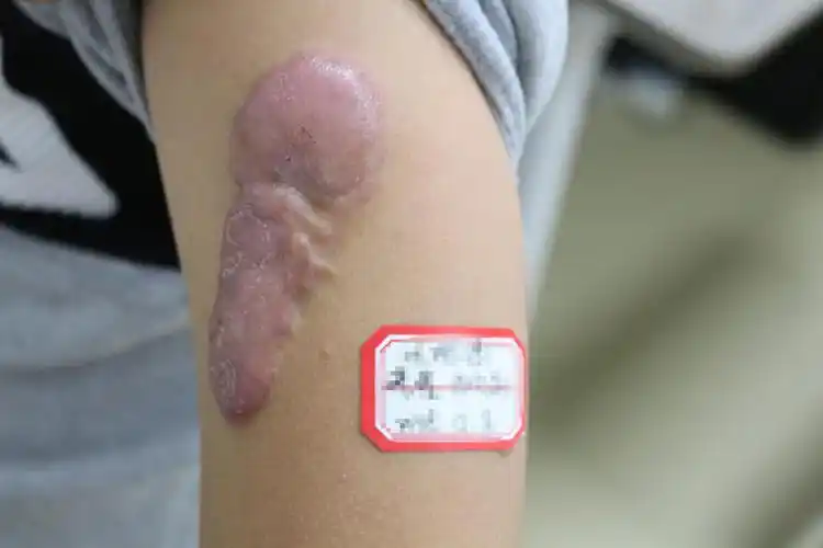 或虽经手术处理仍有明显文身瘢痕,影响军容的,不合格;疤痕