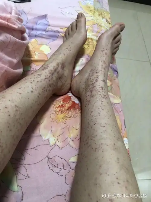 紫癜肾炎患者的这两年