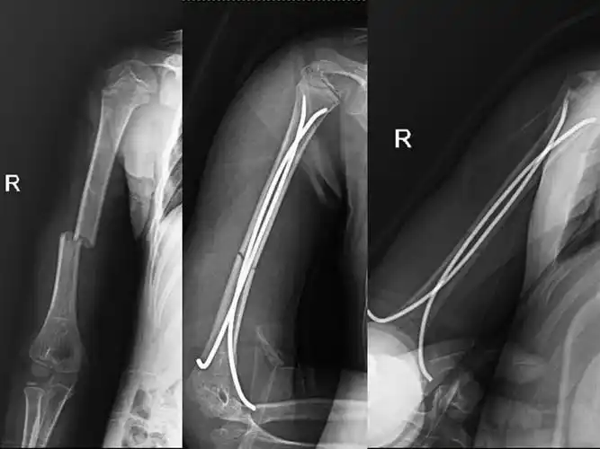 儿童肱骨骨折闭合复位弹性钉内固定儿童肱骨髁上骨折闭合篇