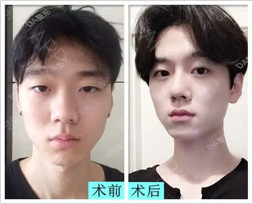男士整形真实案例