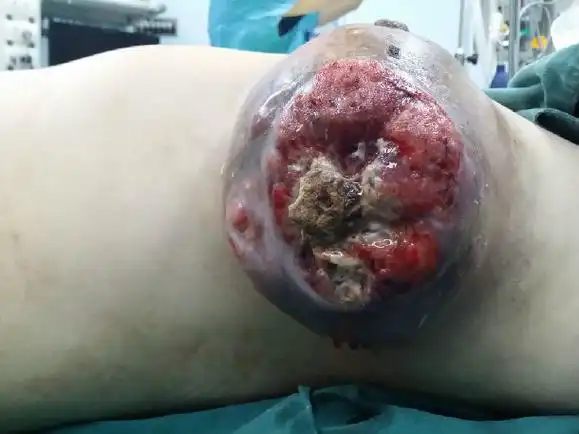 术前化疗的不合理导致乳腺癌迅速增大手术困难大增