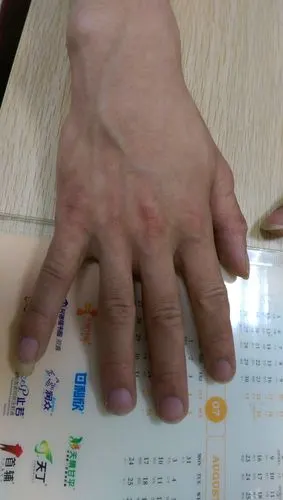 【病例讨论】典型病例2例分享——右上肢远端肌肉萎缩,乏力10余年