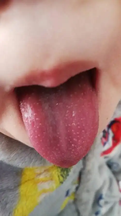 这孩子舌头上这是什么疙瘩