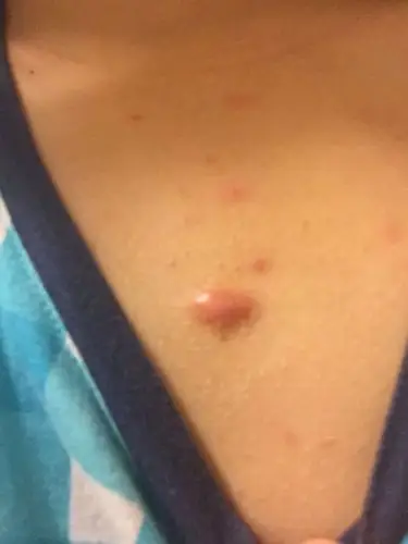 肉芽长在胸口中间的位置,直径大概2厘米左右,没有受过伤,请问怎么