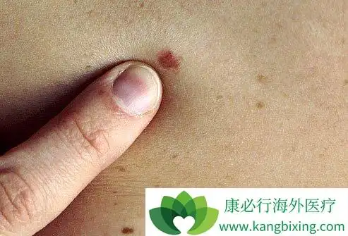 初期皮肤癌症状大多数是基底较硬斑块状丘疹