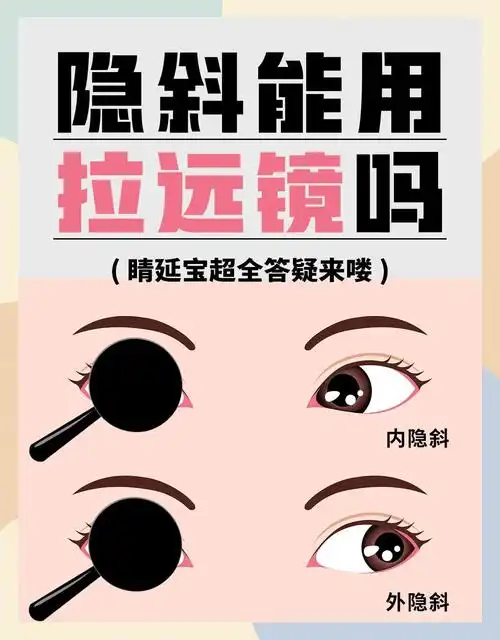 隐斜视是由于眼球的内直肌和外直肌力量不平衡导致的,分为内隐斜和外