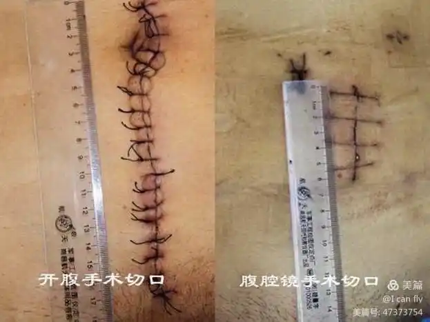 术后患者腹部切口小,与传统开放手术相比,创伤小,恢复快,疼痛少