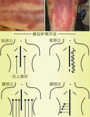 平衡养生之刮痧篇郑州心天教共筑健康