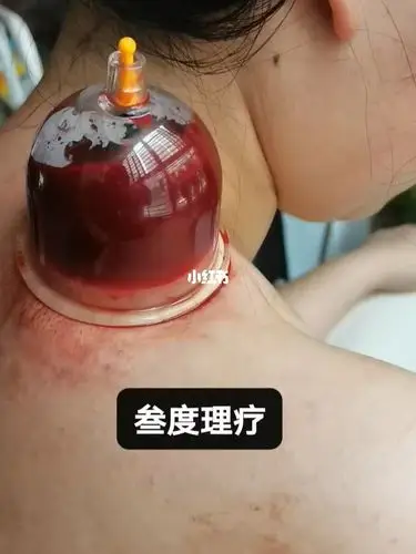 肩周炎_针灸_拔罐_艾灸_理疗_医疗健康_医疗方法