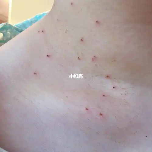 丝状疣最佳治疗方法(丝状疣用什么药膏一涂就掉) 丝状疣最佳治疗方法